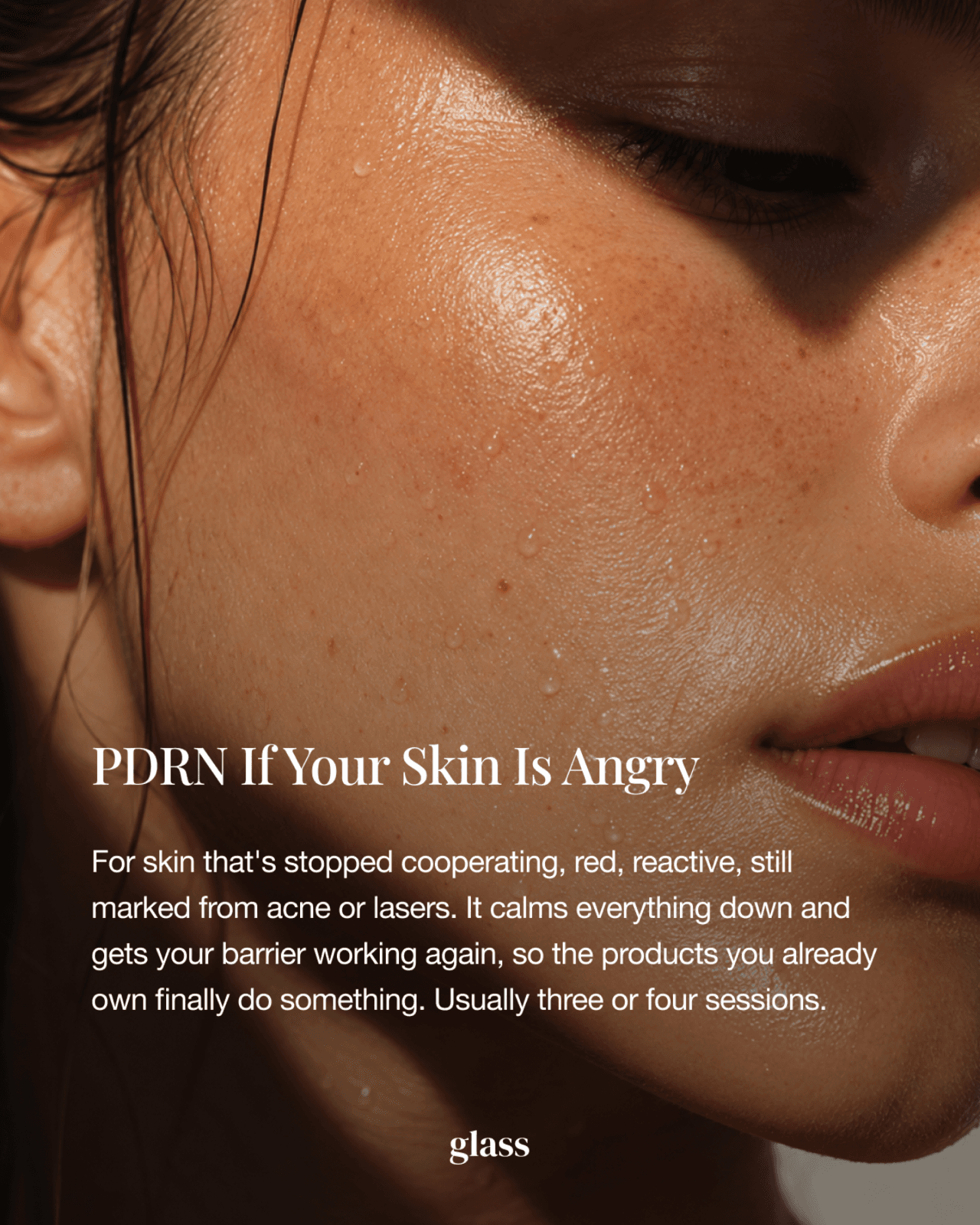PDRN injection for red, reactive skin — Rejuran vs Juvelook vs PDRN skin booster guide