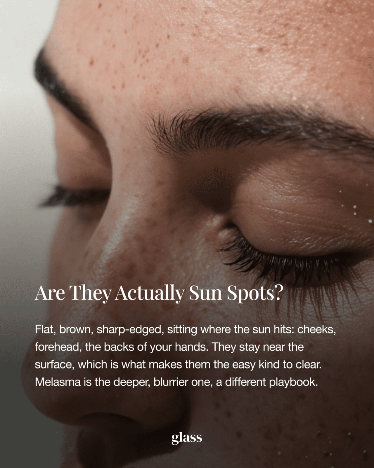 Are they actually sun spots? Flat, brown, sharp-edged spots versus deeper, blurrier melasma